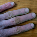 Purple Hands: Raynauds Symptoms