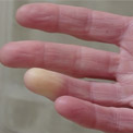 What's the Difference Between Primary and Secondary Raynaud's?