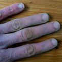 Purple Hands: Raynaud’s Symptoms
