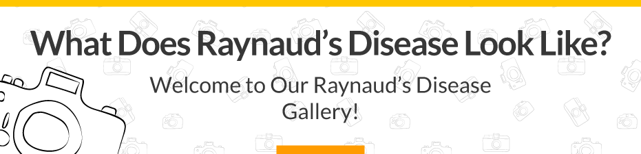 Welcome to Our Raynaud's Symptom Photos Gallery!