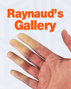 Raynaud's Gallery